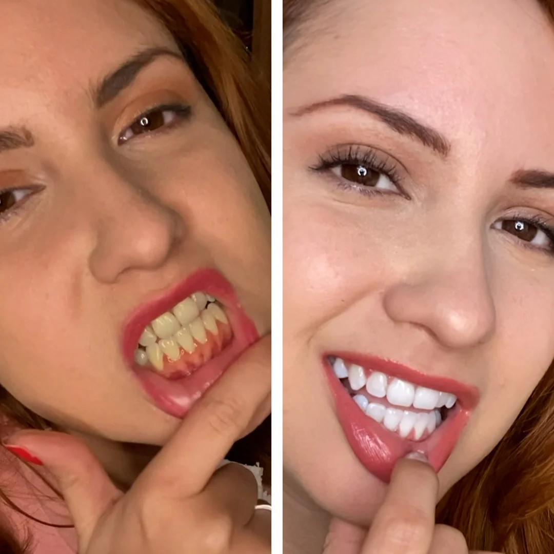 Teeth Whitening — Before/After Split Screen