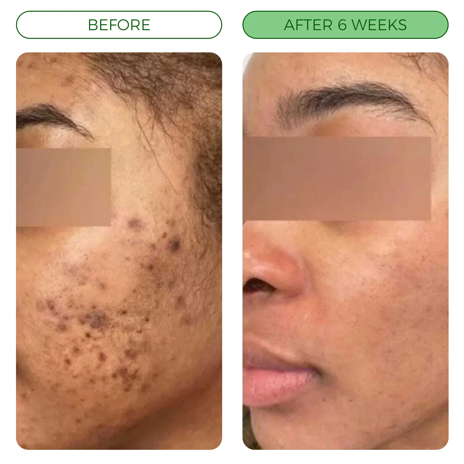 Skincare Before/After — Direct Comparison Layout