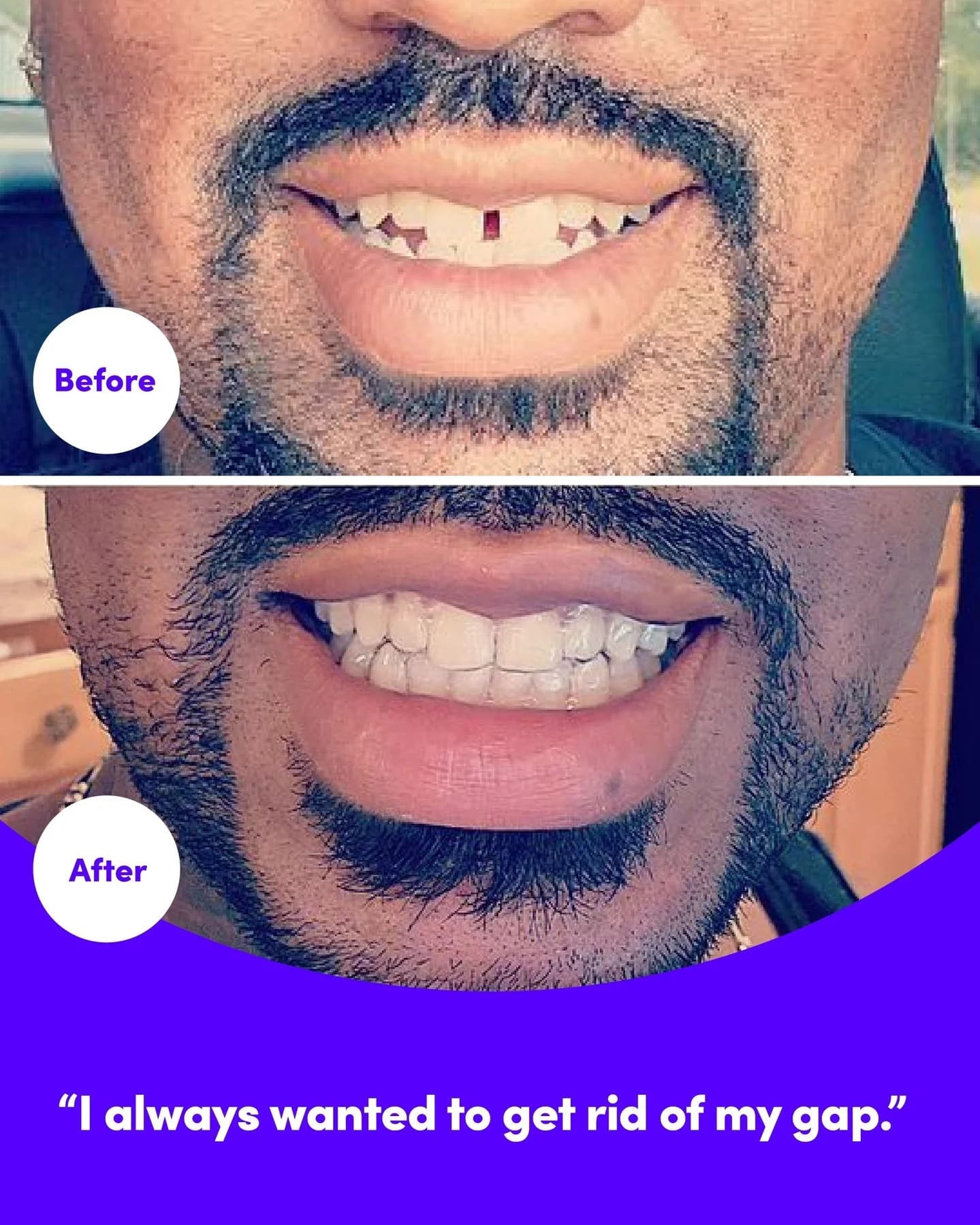 Dental Aligner Testimonial — Before/After Split