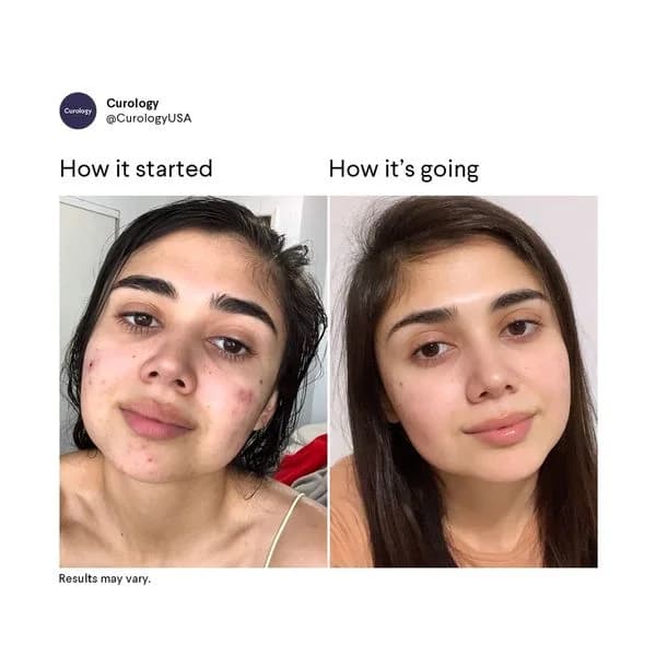 Curology Acne Treatment — Before/After Split Screen
