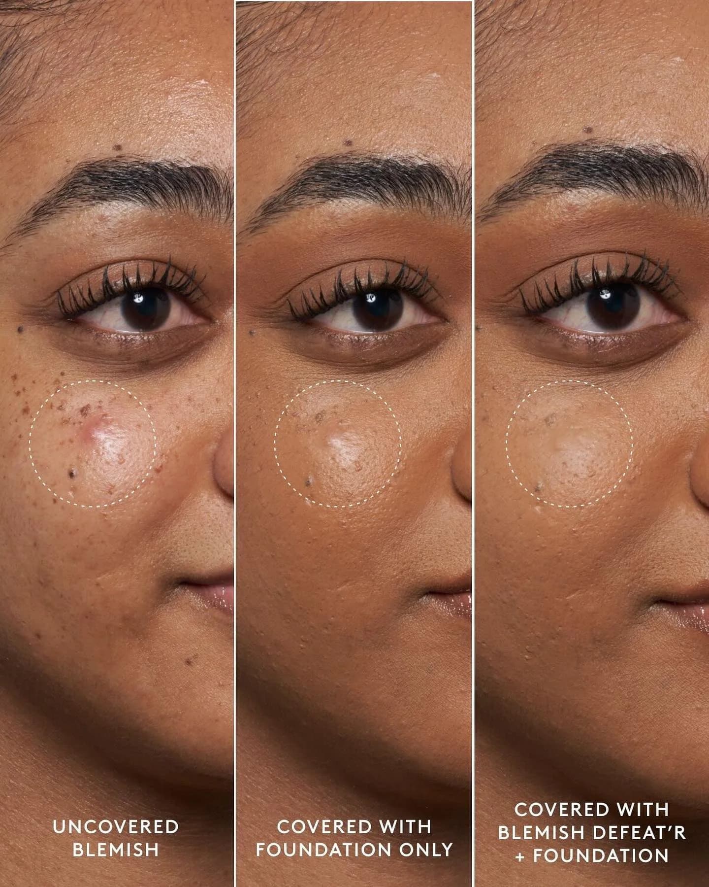 Blemish Coverage — Triple Comparison Layout